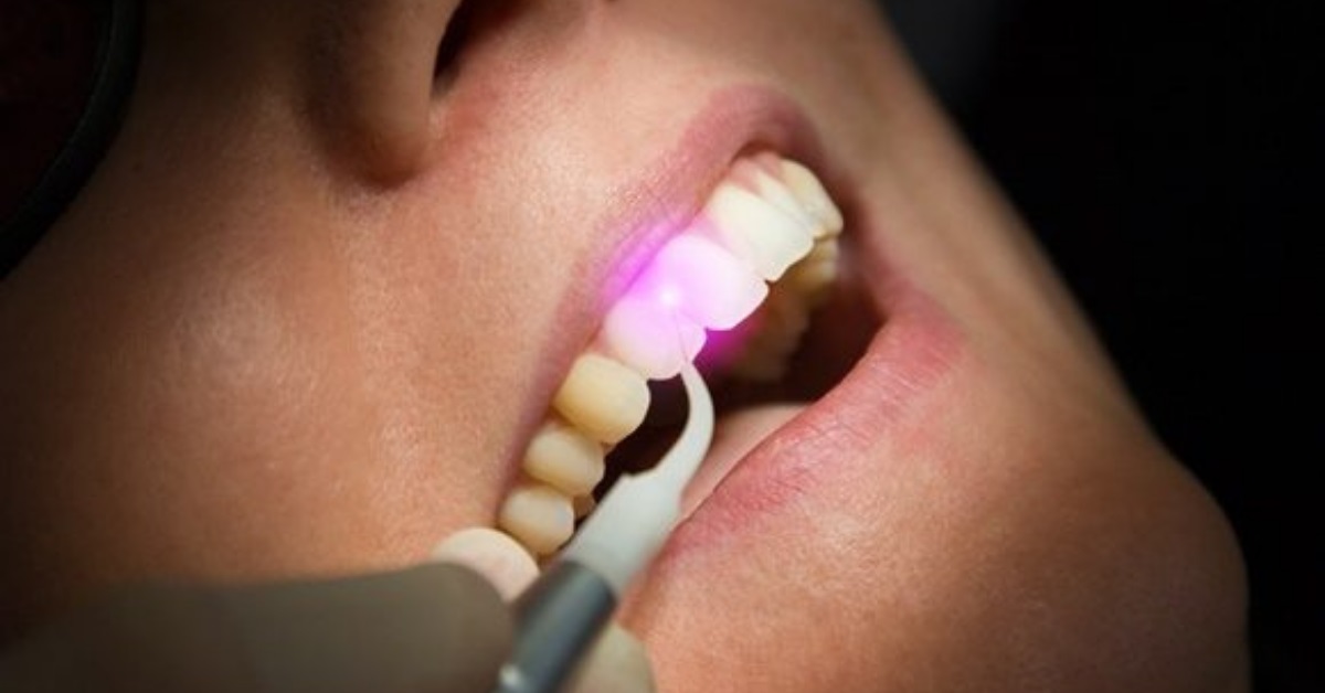 دند انپزشکی با لیزر