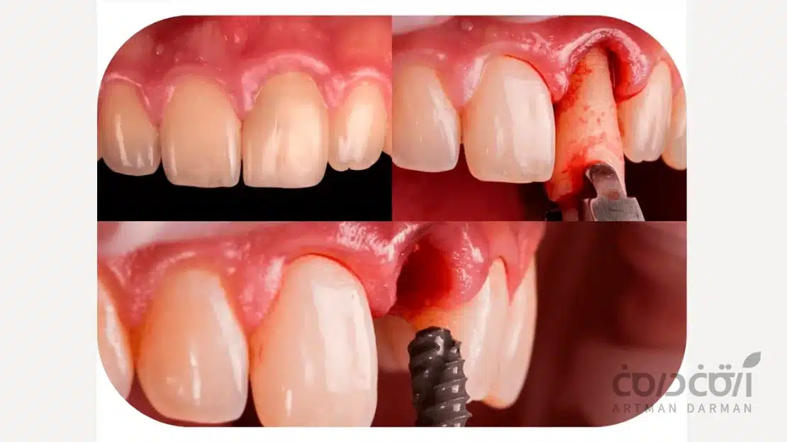 ایمپلنت فوری دندان جلو