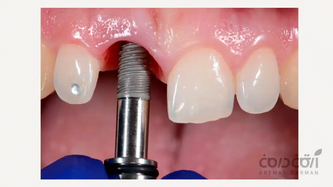 تصویری از مرحله نصب فیکسچر