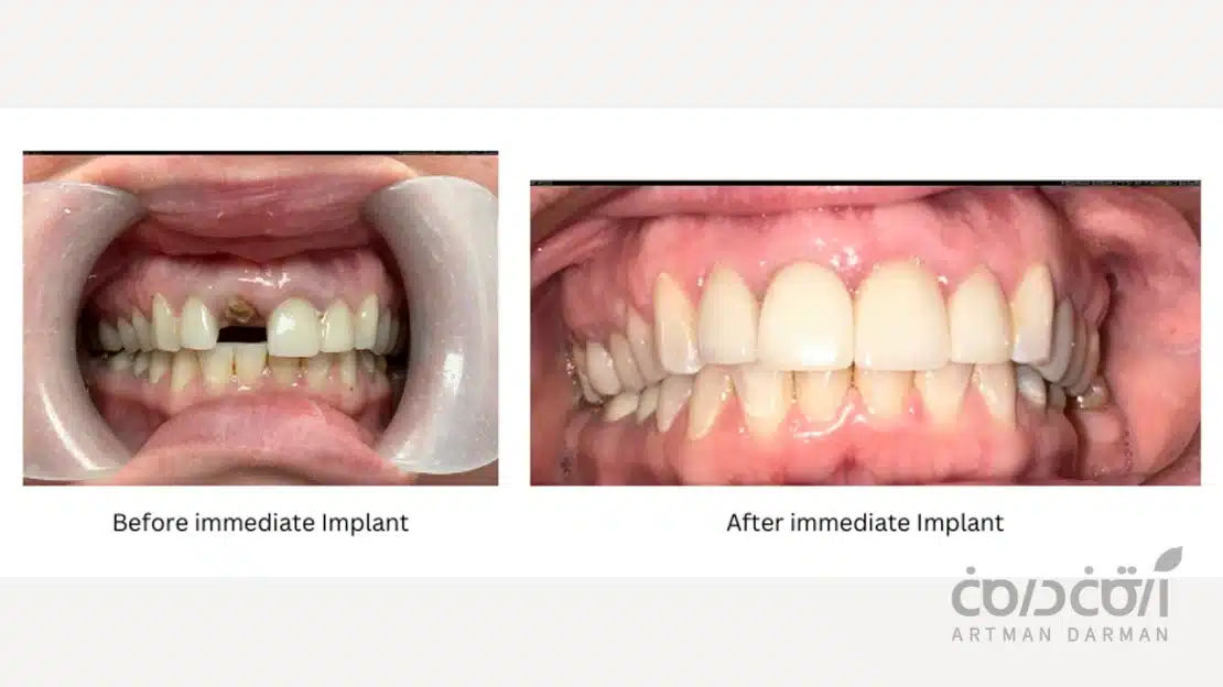 قبل و بعد از انجام ایمپلنت فوری