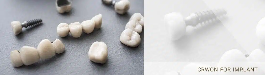 عکس تعدادی روکش دندان برای ایمپلنت