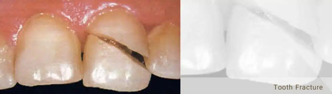 تصویر دندان شکسته 