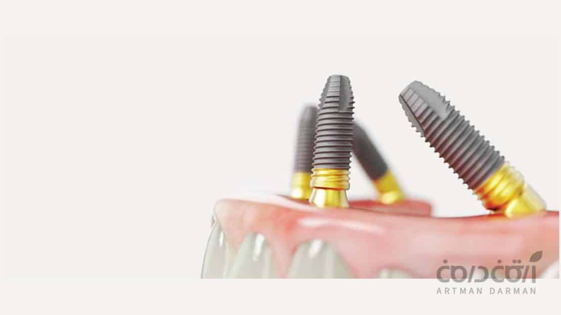 معرفی شناخته شده ترین و بهترین برندهای ایمپلنت دندان در جهان ایمپلنت Nobel Biocare