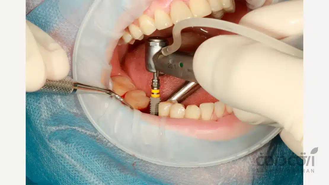 ایمپلنت Nobel Biocare 