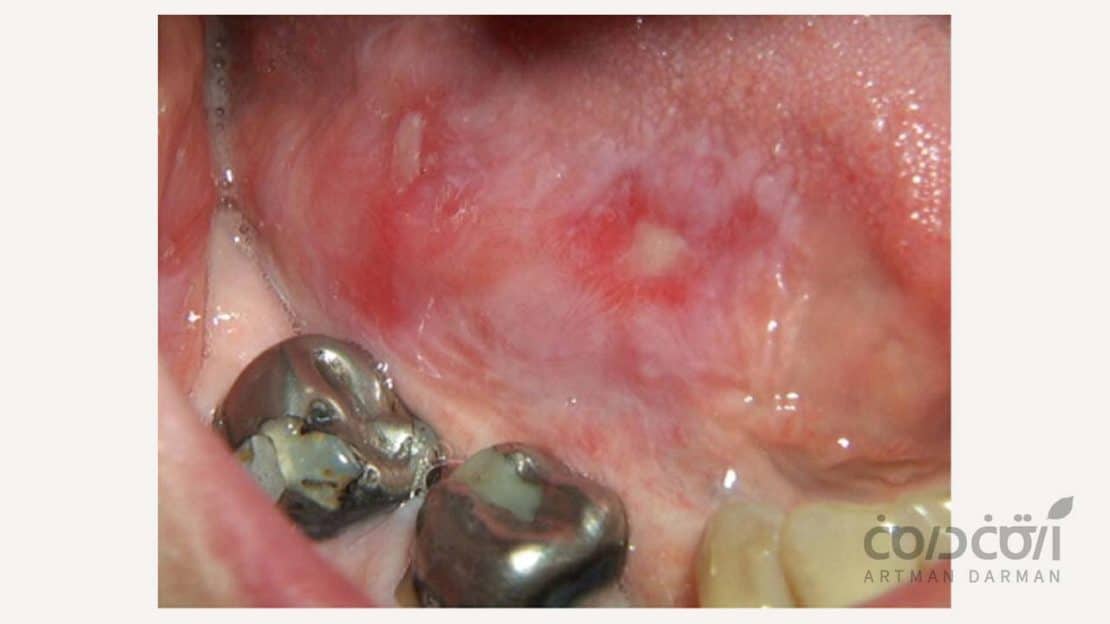 واکنش های آلرژیک