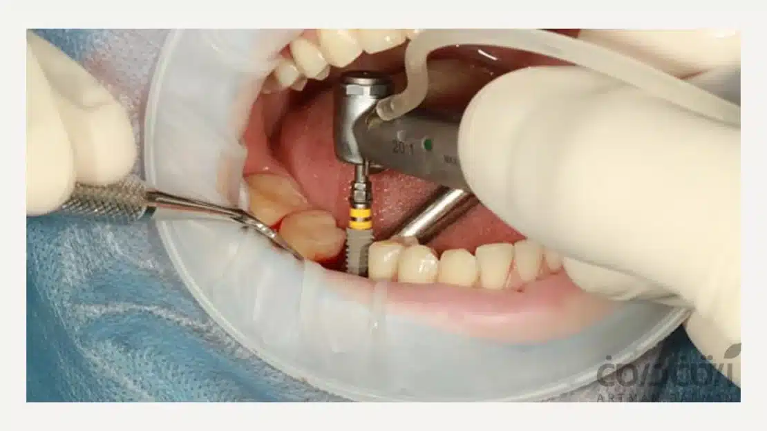 ایمپلنت آنتوژیر