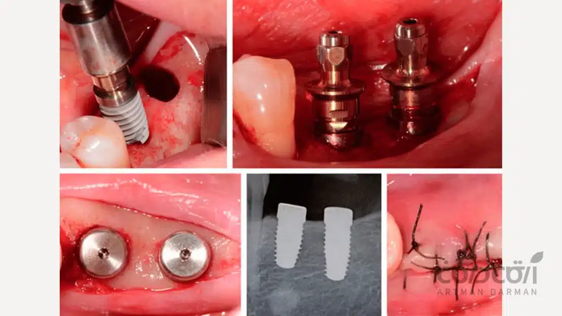 رژیم غذایی نرم