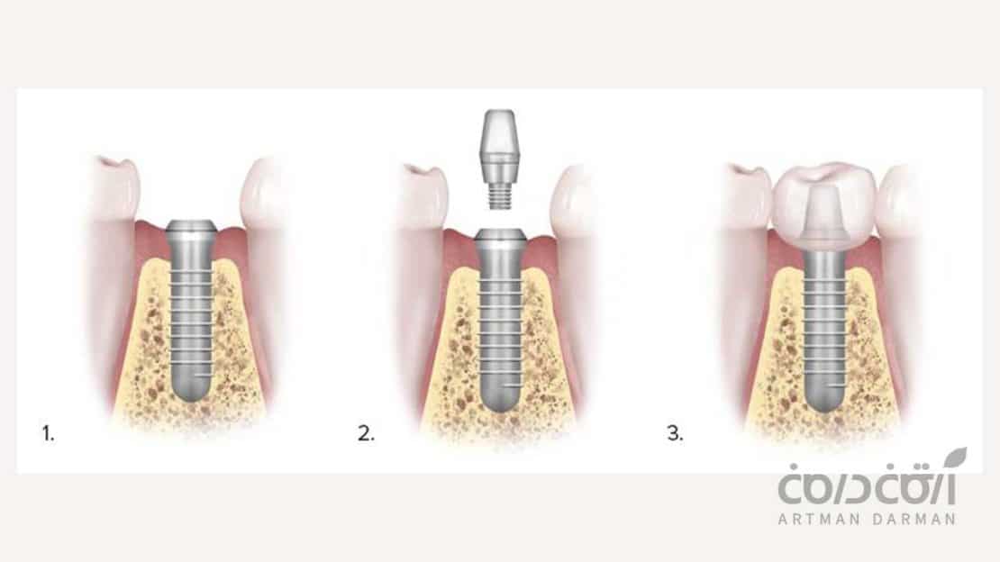 مراحل درمان ایمپلنت دندان