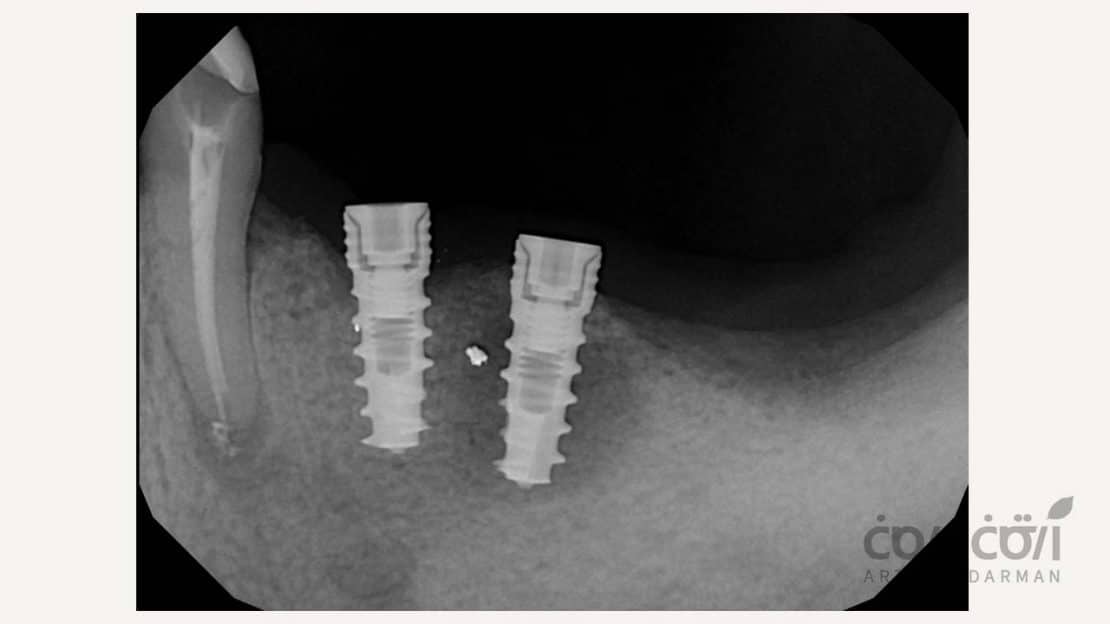 پری ایمپلنتیت