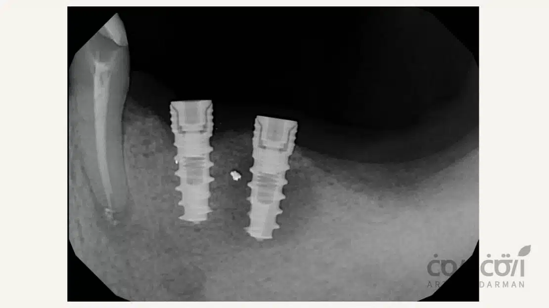 پری ایمپلنتیت