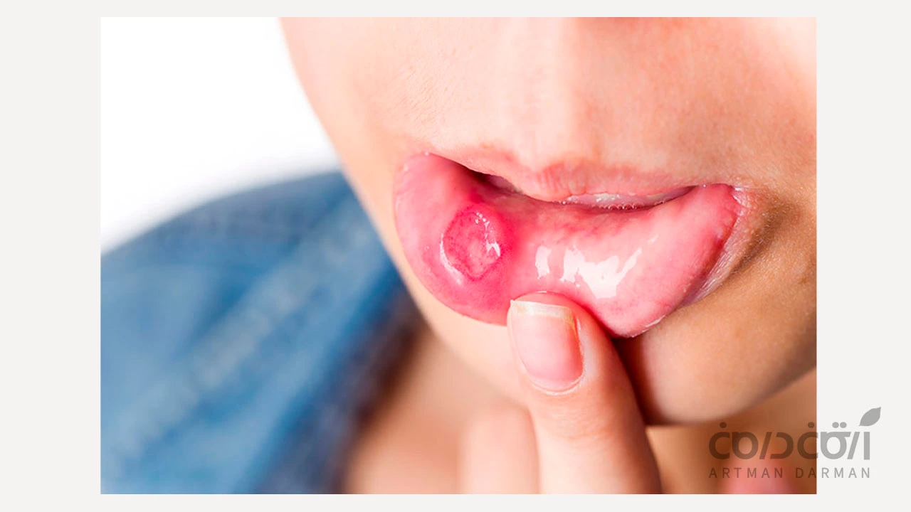 تصویر پسری با آفت دهان