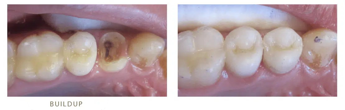 بیلداپ دندان یکی از درمان های دندانپزشکی دندان درد