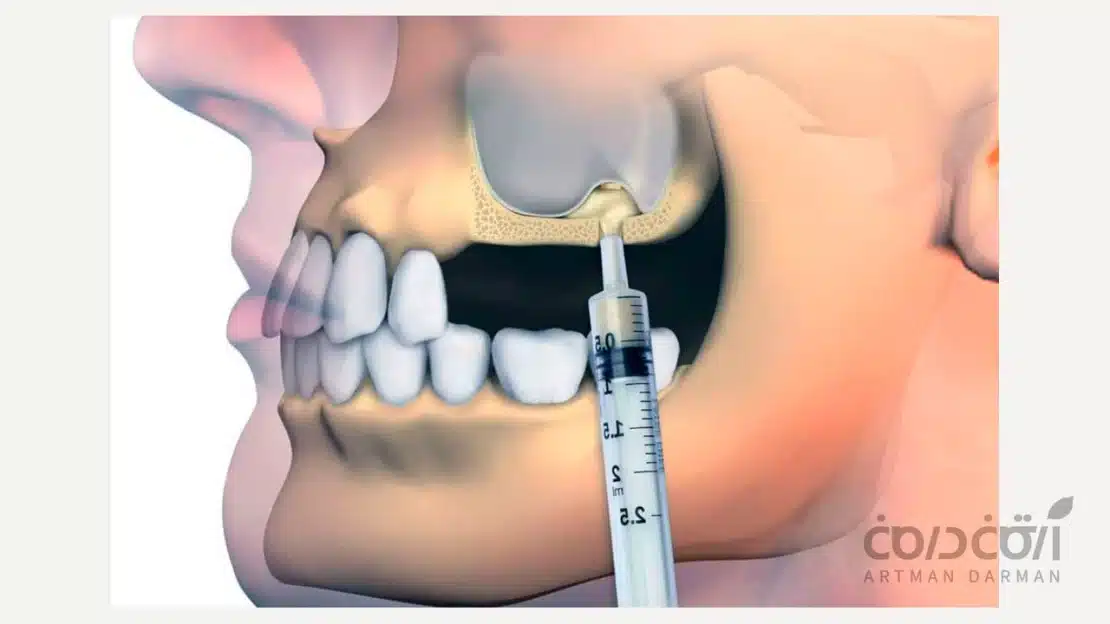 تصویری از نحوه عمل لیفت سینوس
