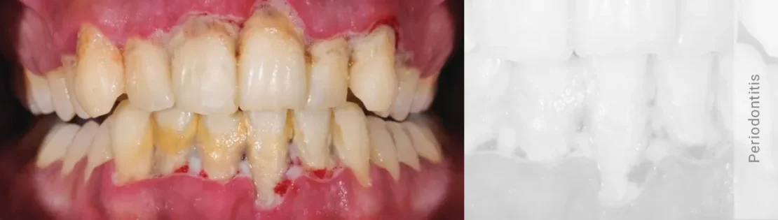 تصویر پریودنتیت پیشرفته