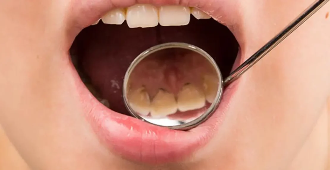 عکس پلاک دندان