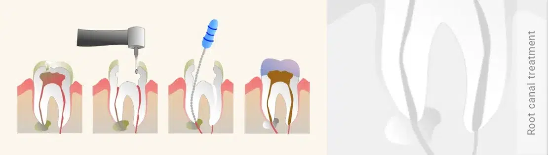 تصویری از درمان ریشه دندان