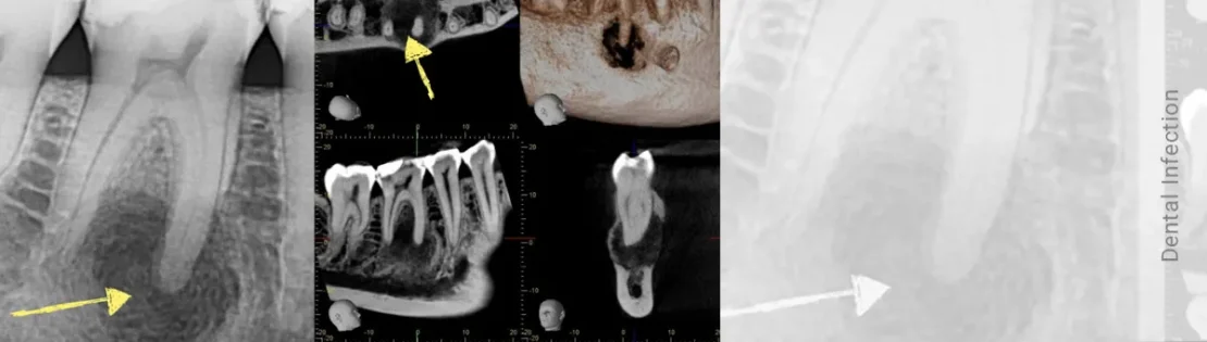تصویر اشعه ایکس دندان