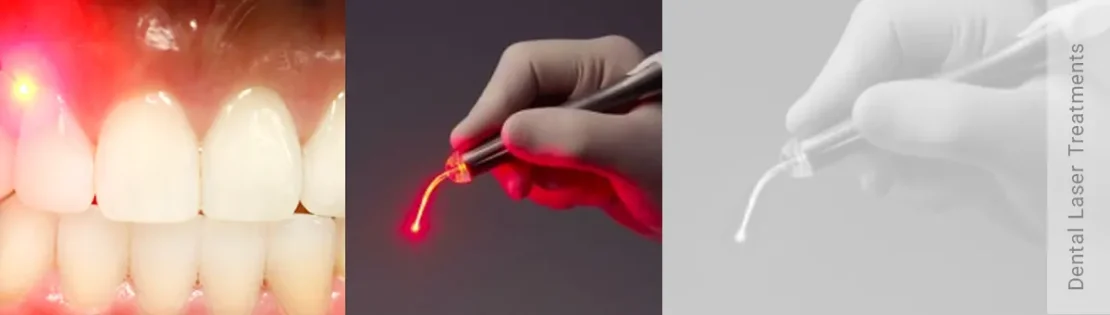لیزر دندانپزشکی