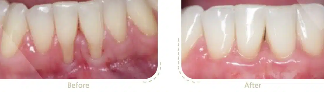 جراحی لثه برای خارج کردن پلاک و جرم دندان