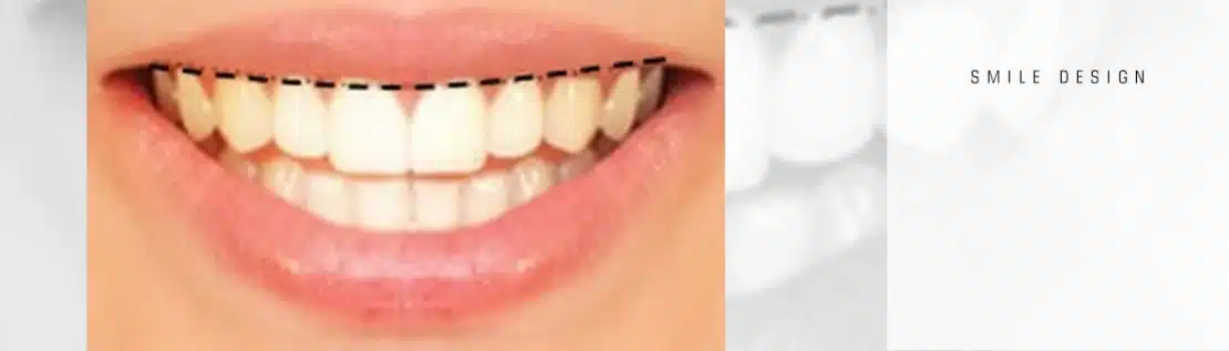 خط لثه 
