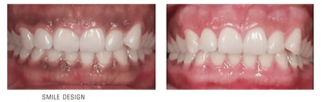 اصلاح طرح لبخند قبل و بعد از اصلاح طرح لبخند