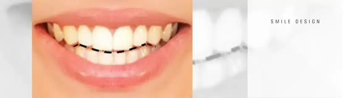 تاثیر شکل لبه دندان در طرح لبخند
