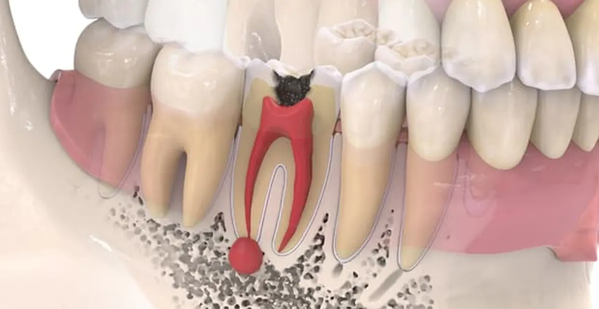 عکس عفونت دندان