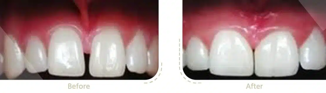 وجود فاصله بین دندان ها به دلیل بزرگتر شدن زائده فرنوم و برداشتن این زائده با لیزر