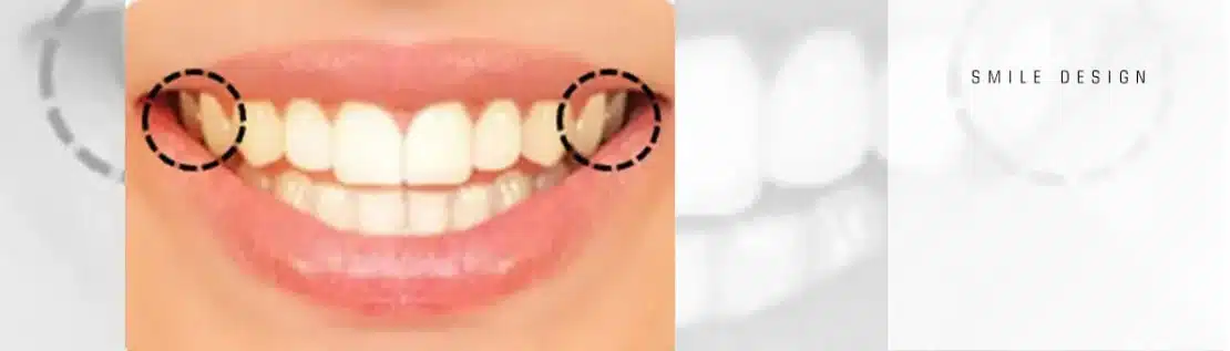 پهنای لبخند در اصلاح طرح لبخند