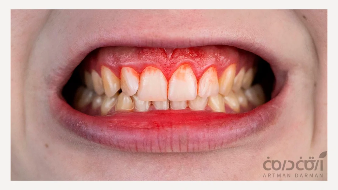 خونریزی لثه