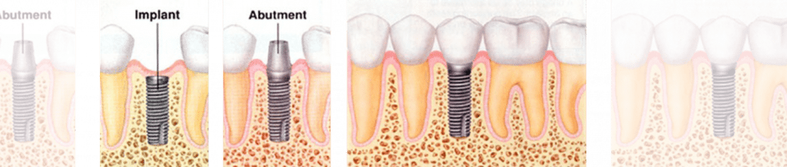 بخش های مختلف ایمپلنت