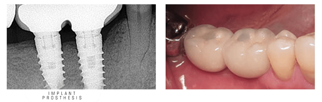عکس روکش ایمپلنت