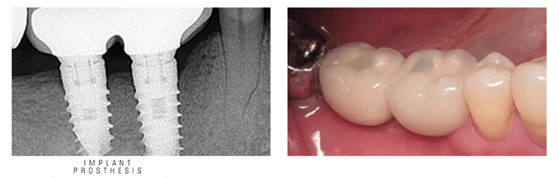 عکس روکش ایمپلنت