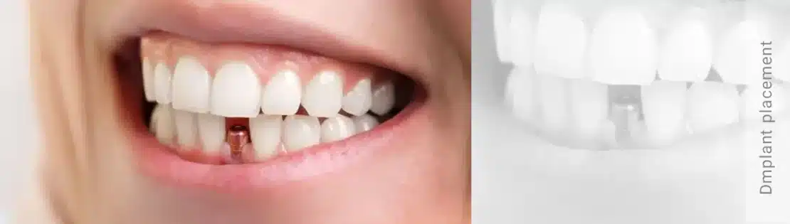 ایمپلنت دندان جلویی