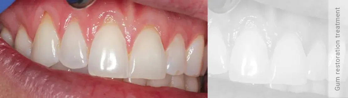 عکسی از تحلیل لثه