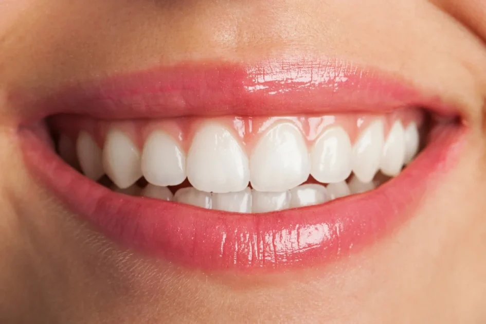 تفاوت بلیچینگ و جرم‌گیری دندان در چیست؟
