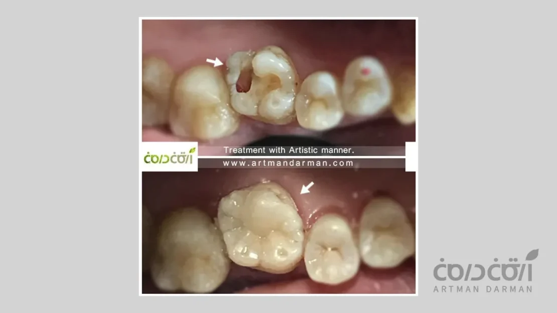 تصویری از روش درمان محافظه کارانه در دندانپرشکی