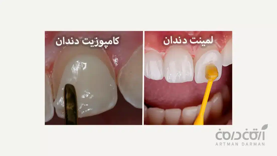 تصویر نشان دهنده تفاوت لمینت و کامپوزیت 