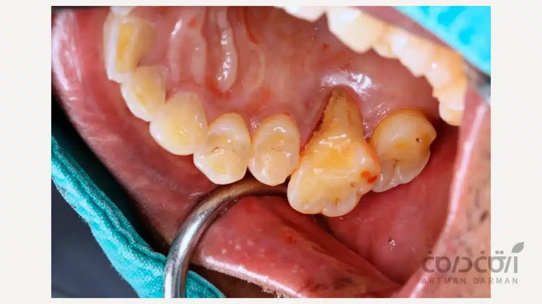 لق شدن دندان به دلیل بیماری لثه