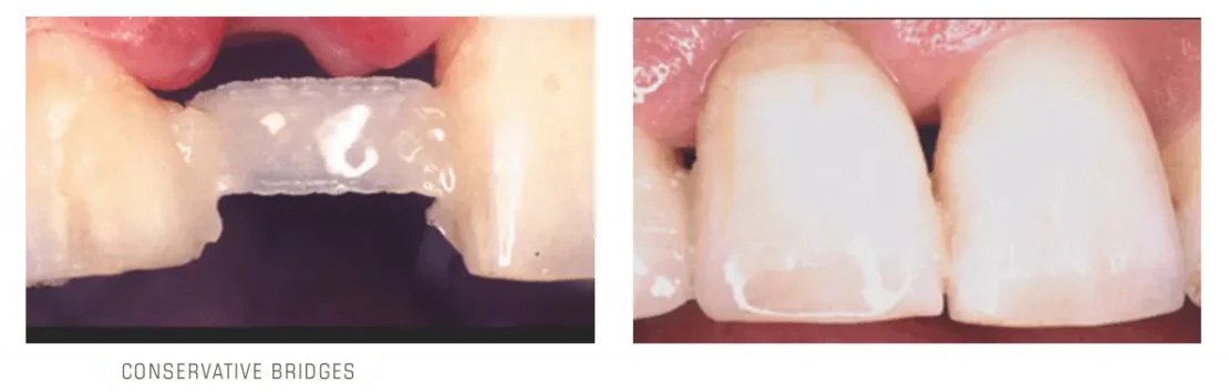 بریج محافظه کارانه