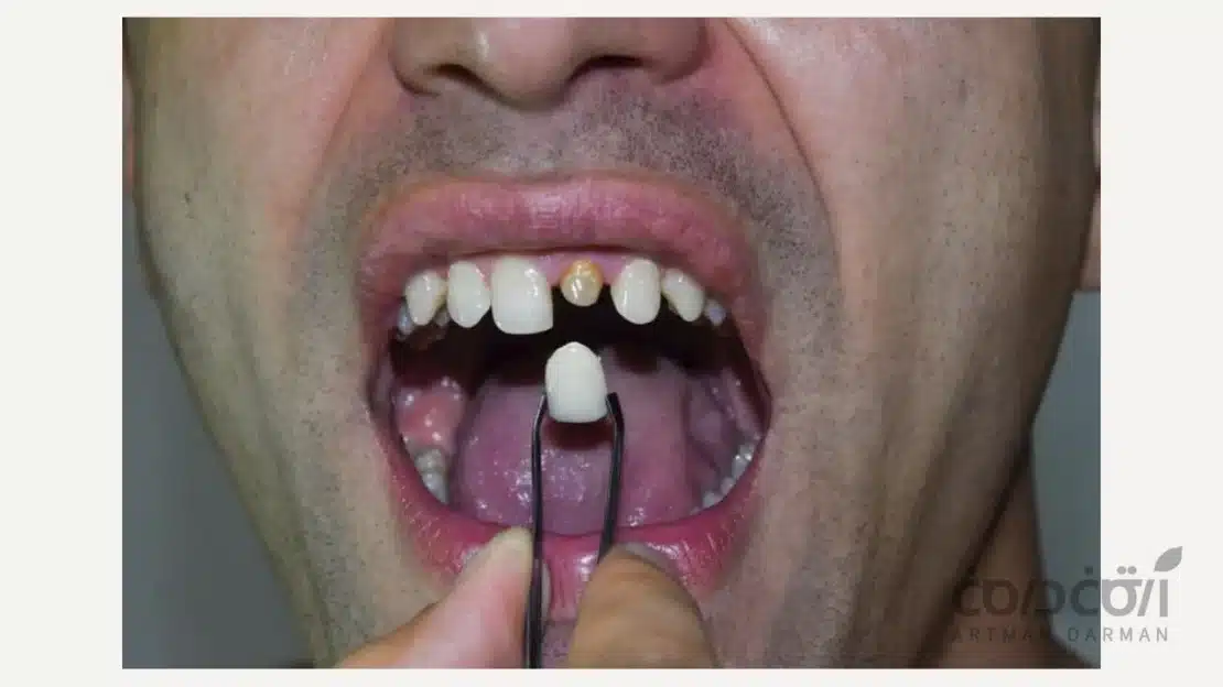 روکش دندان جلو