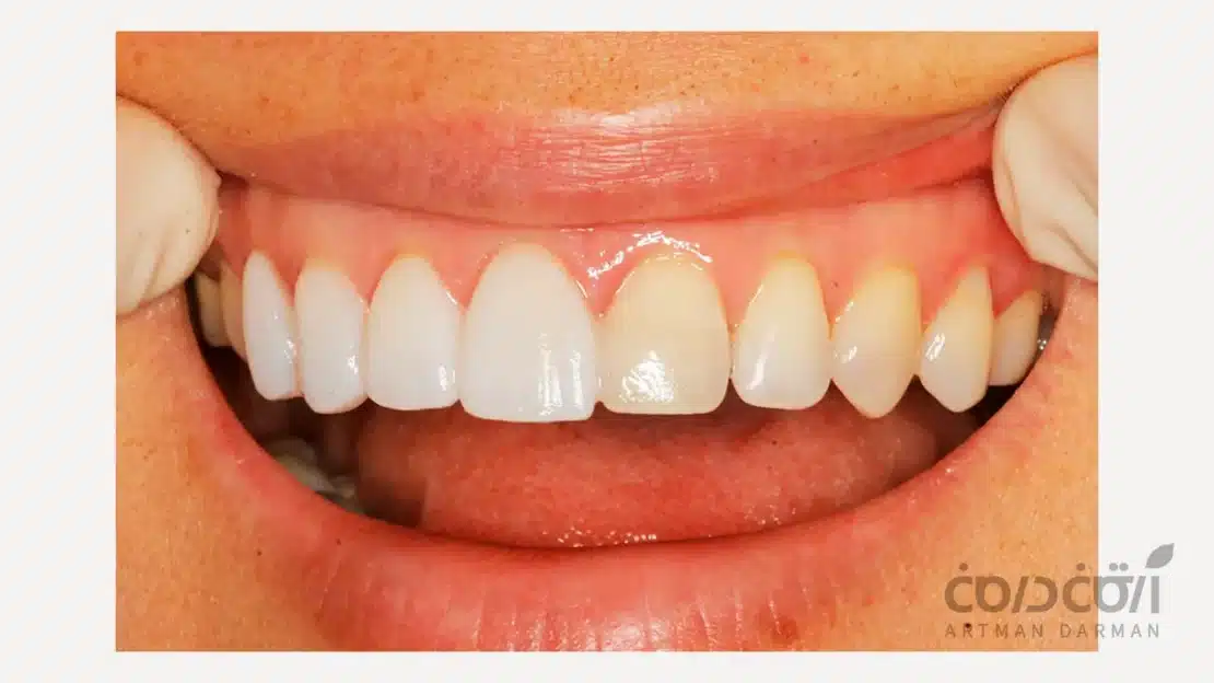 لومینیرز دندان