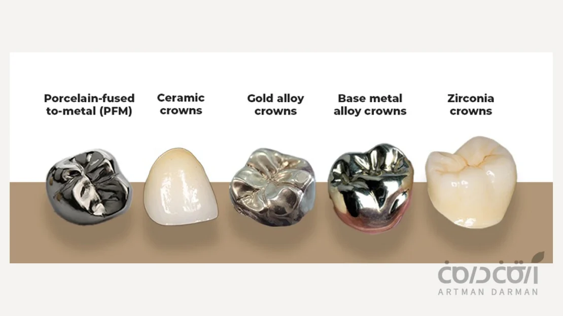 انواع روکش دندان