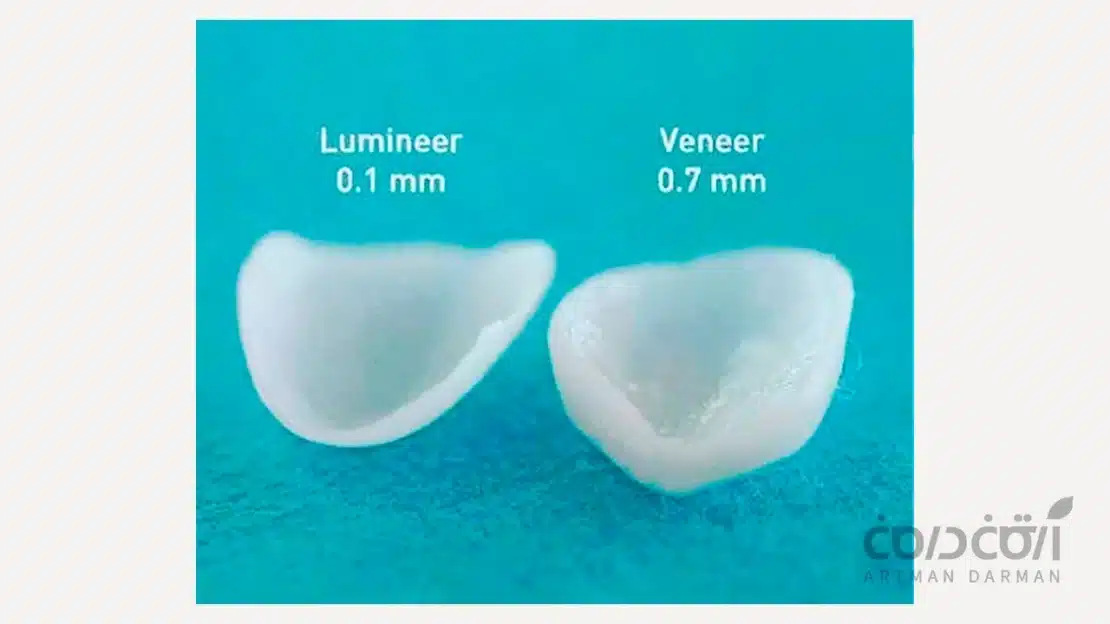تفاوت ضخامت لومینیرز و لمینت دندان