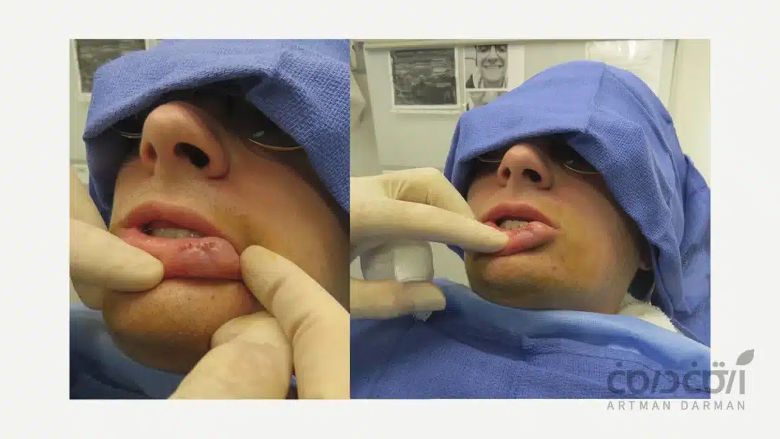 جراحی موکوسل دهان