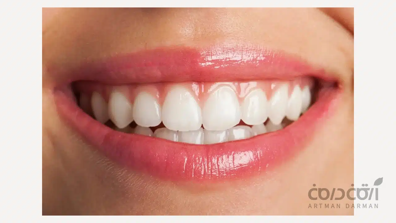 تفاوت جرم گیری و بلیچینگ دندان