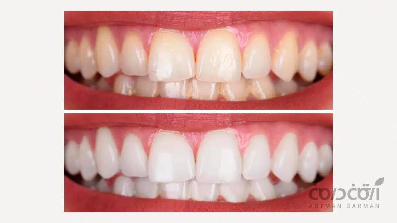 تفاوت بلیچینگ و جرمگیری دندان