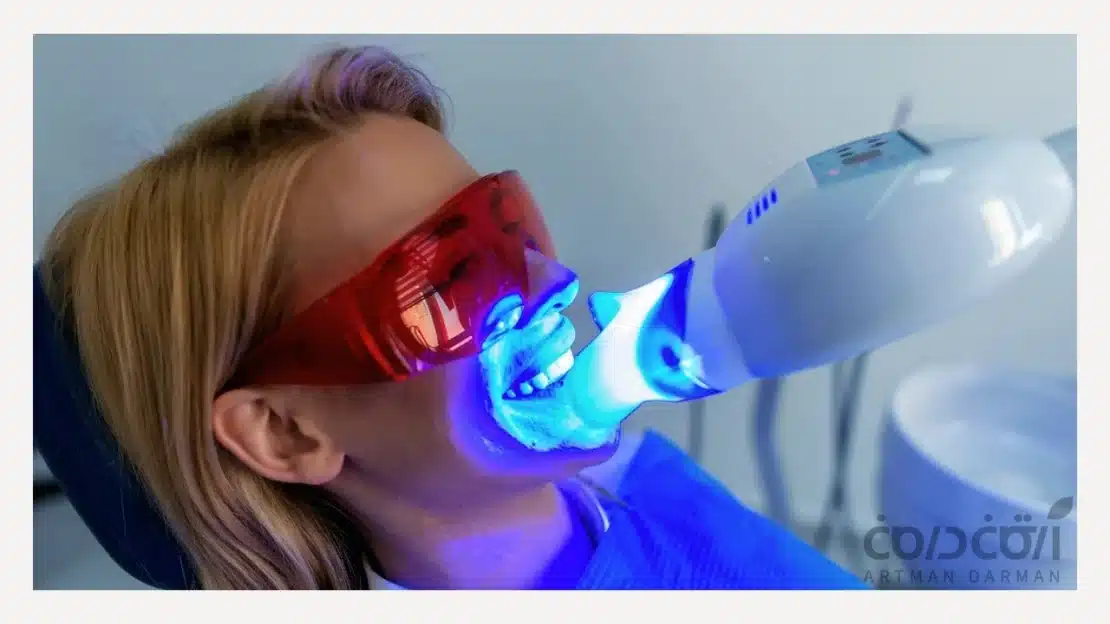 بلیچینگ دندان در مطب