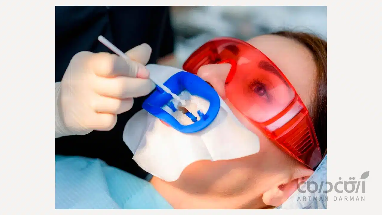 بلیچینگ دندان