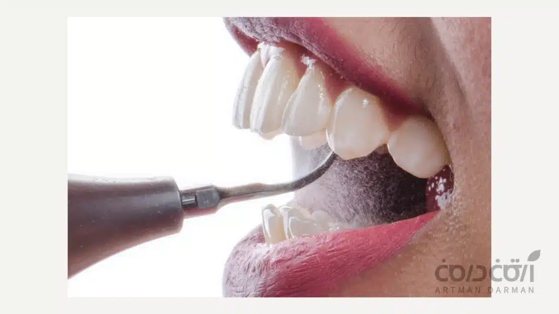 جرم گیری دندان